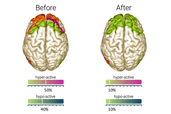 EEG software showing results for before and after psilocybin therapy