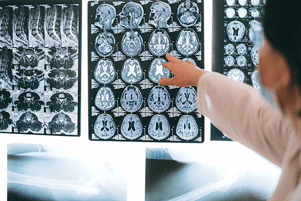 A doctor going over some brain scans